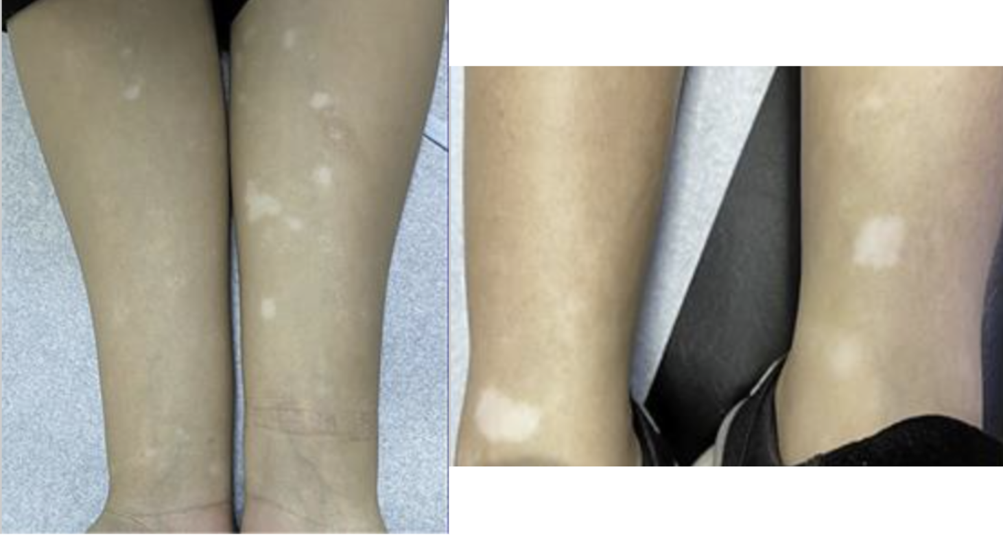 Cas de vitiligo suite à une épilation au laser.