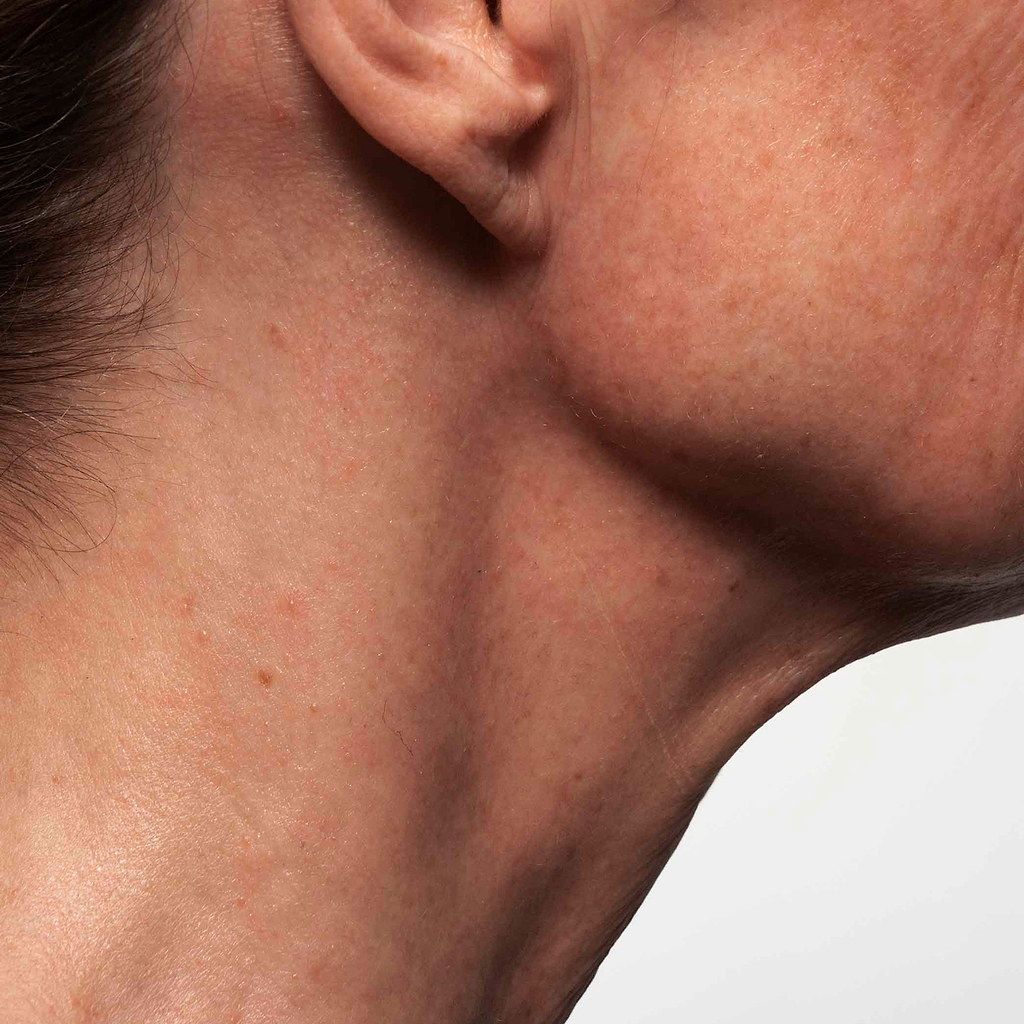 Hormones qui influent sur la peau.