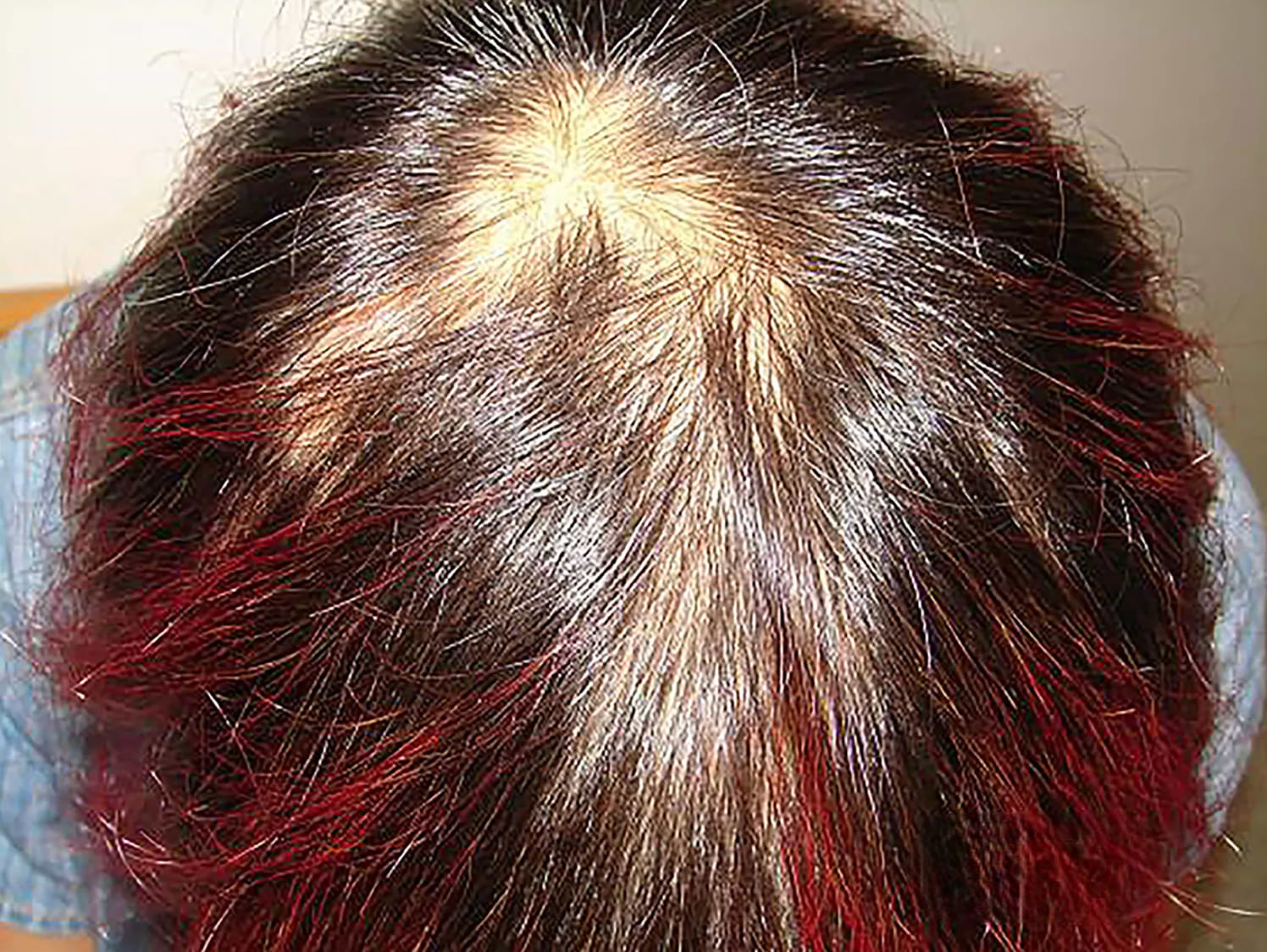 Alopécie non-cicatricielle lupus.