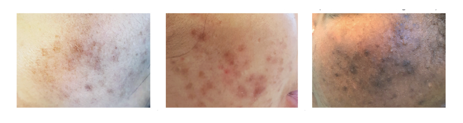 Hyperpigmentation post-inflammatoire à différents degrés.