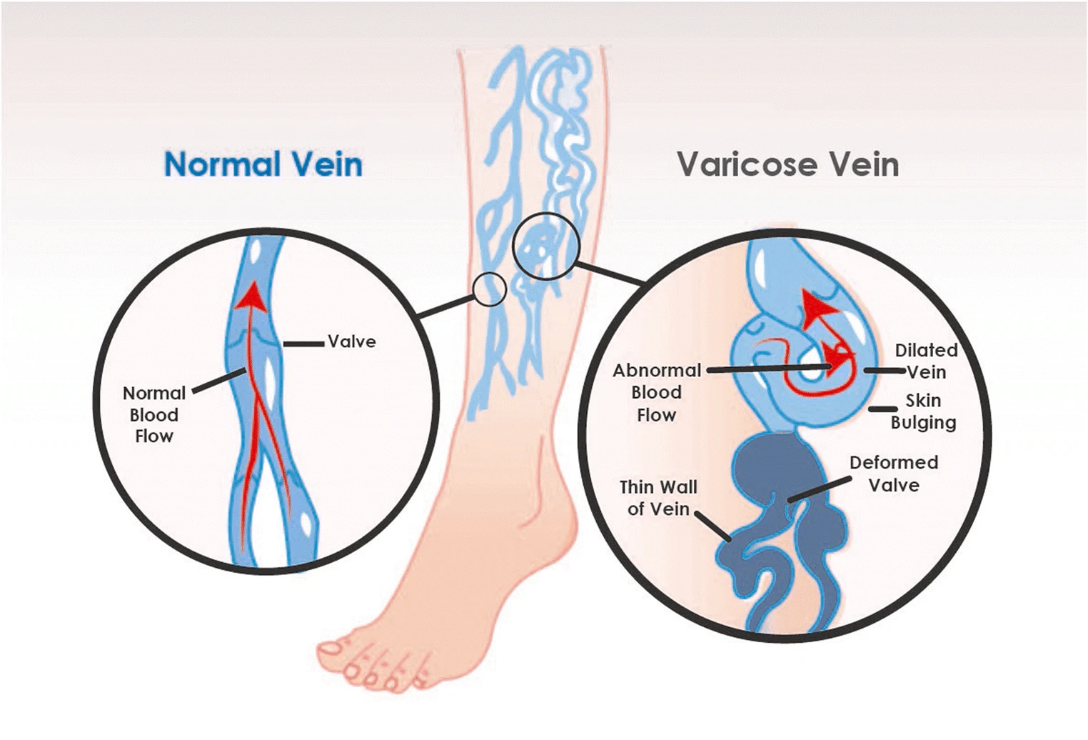Normal versus varicose veins.