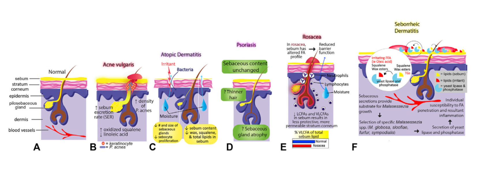 Le rôle des glandes sébacées dans (A) une peau normale, (B) l'acné, (C) l'eczéma, (D) le psoriasis, (E) la rosacée et (F) la dermatite séborrhéique.