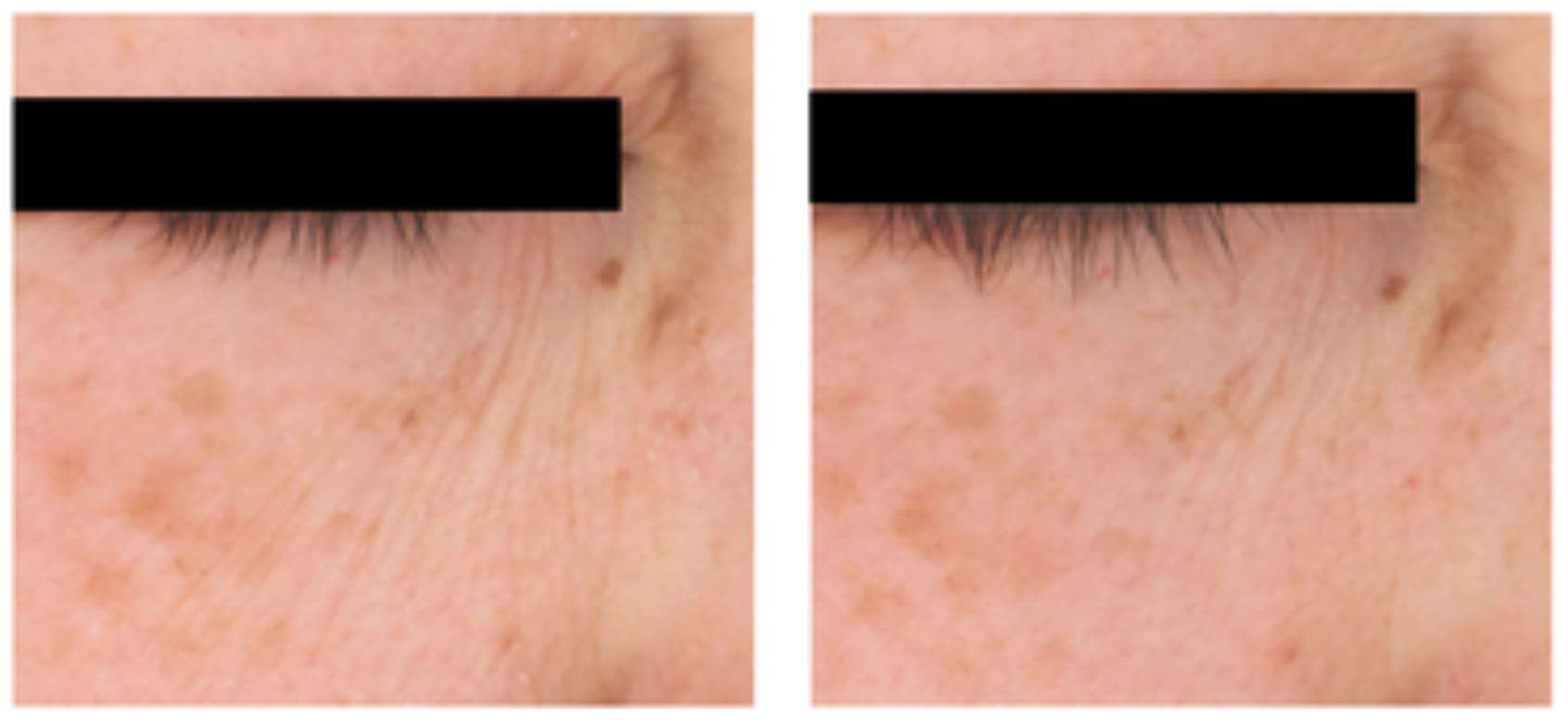 Contour des yeux d'une participante avant et après quatre semaines d'utilisation du sérum à 0,1% de rétinol.