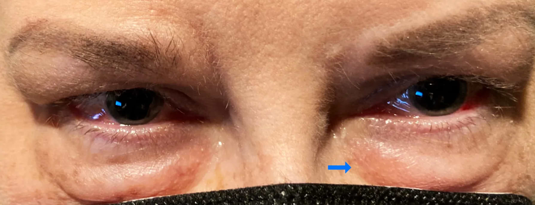 Poches sous les yeux après traitement lupus Méthotrexate.