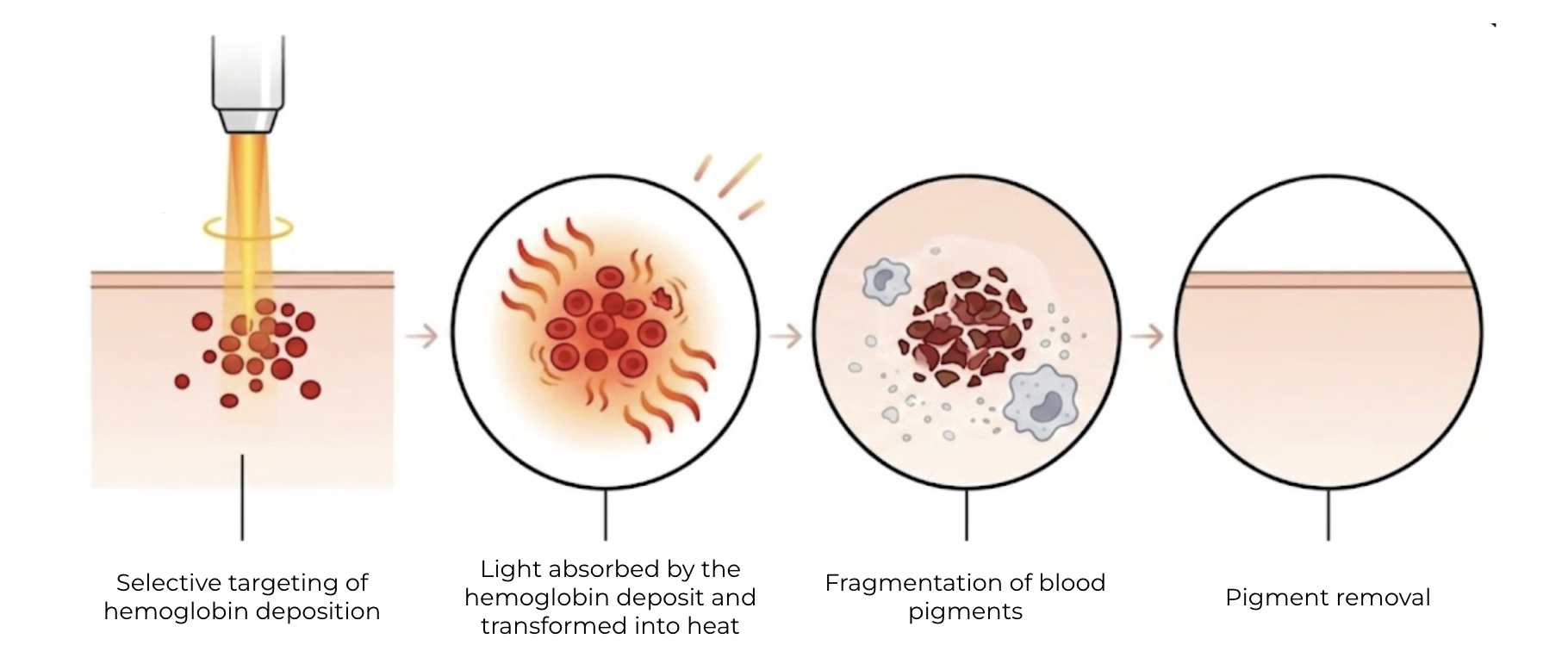 Mécanisme de fonctionnement du laser vasculaire.