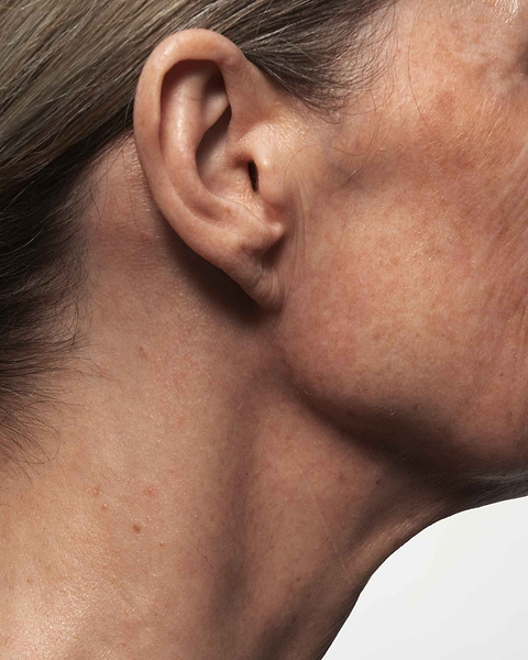 L'acide glycolique peut-il assécher la peau ?