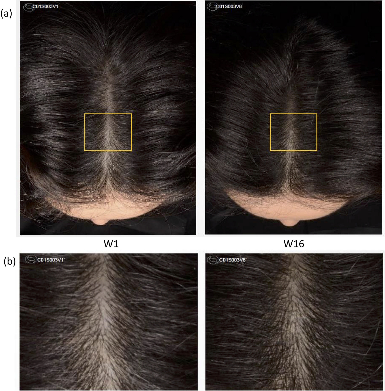 Effet visuel de la lotion capillaire sur le cuir chevelu d’une participante avec une amélioration après 16 semaines d’utilisation.