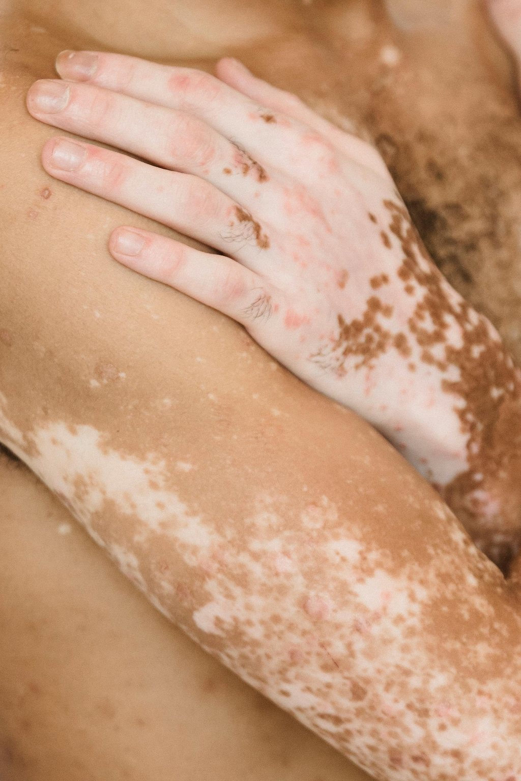 Traitements vitiligo génital.