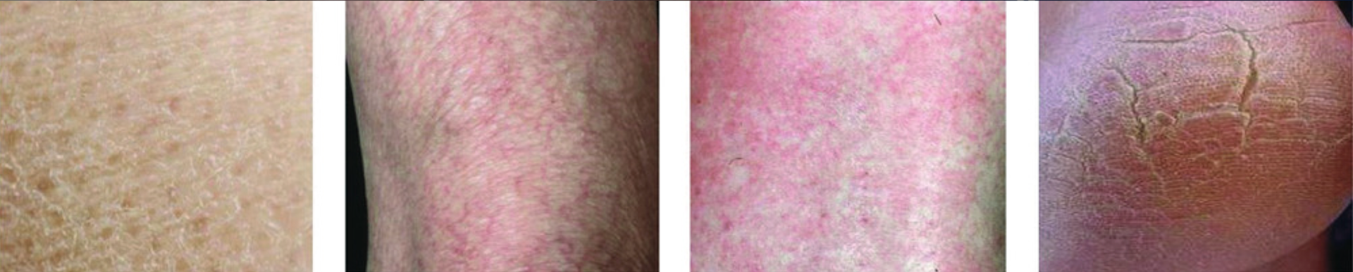 Exemples cliniques de xérose cutanée.