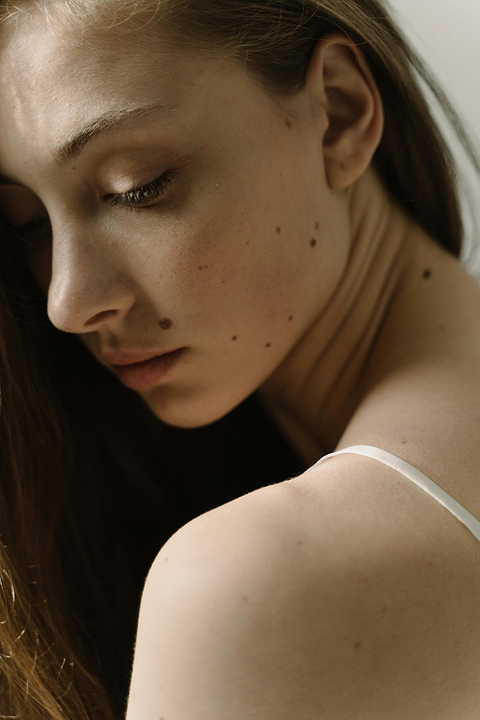 Mécanisme de formation d'un grain de beauté.