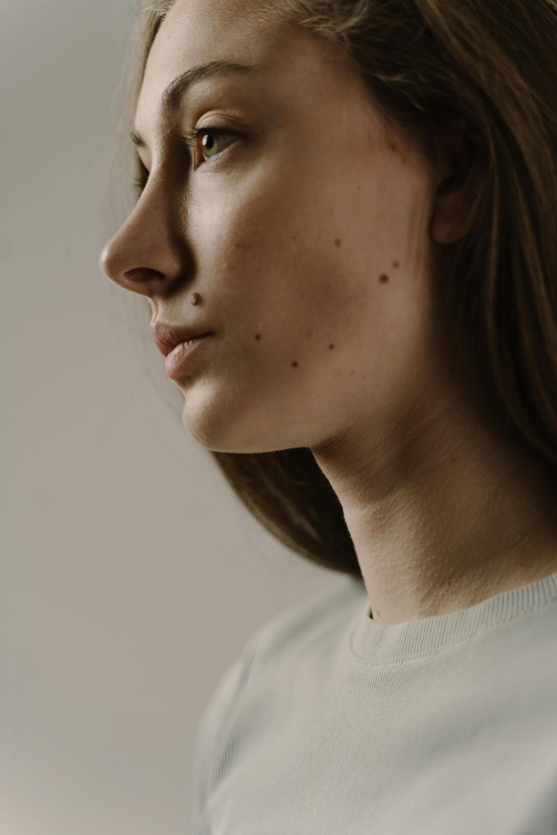 Le Roaccutane pour affiner le nez.