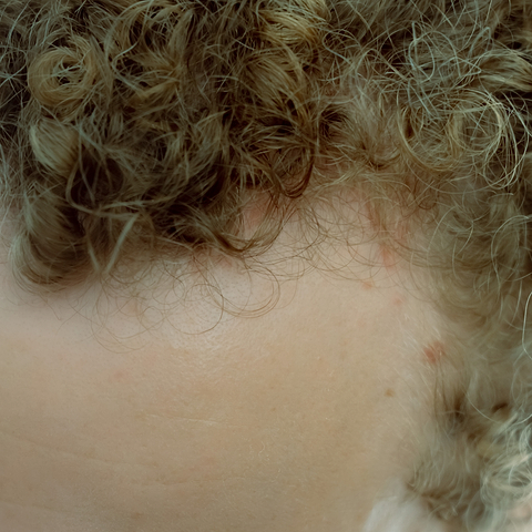 Interview dermatologue psoriasis cuir chevelu.