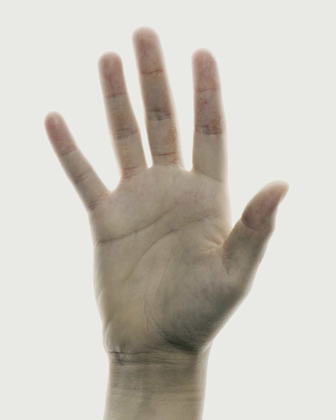HECSI et eczéma des mains.