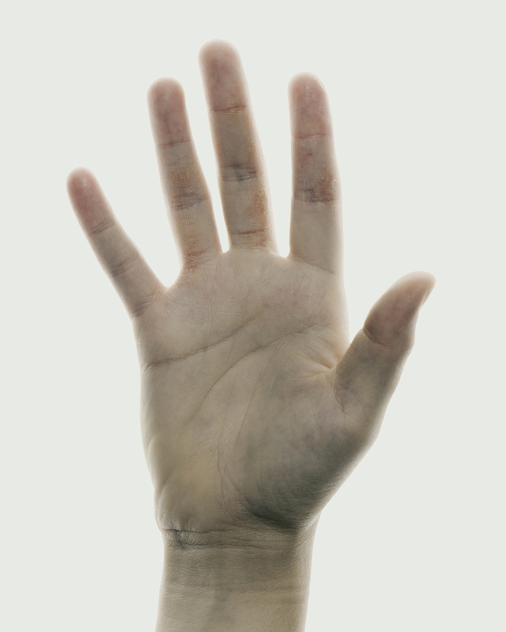 HECSI et eczéma des mains.