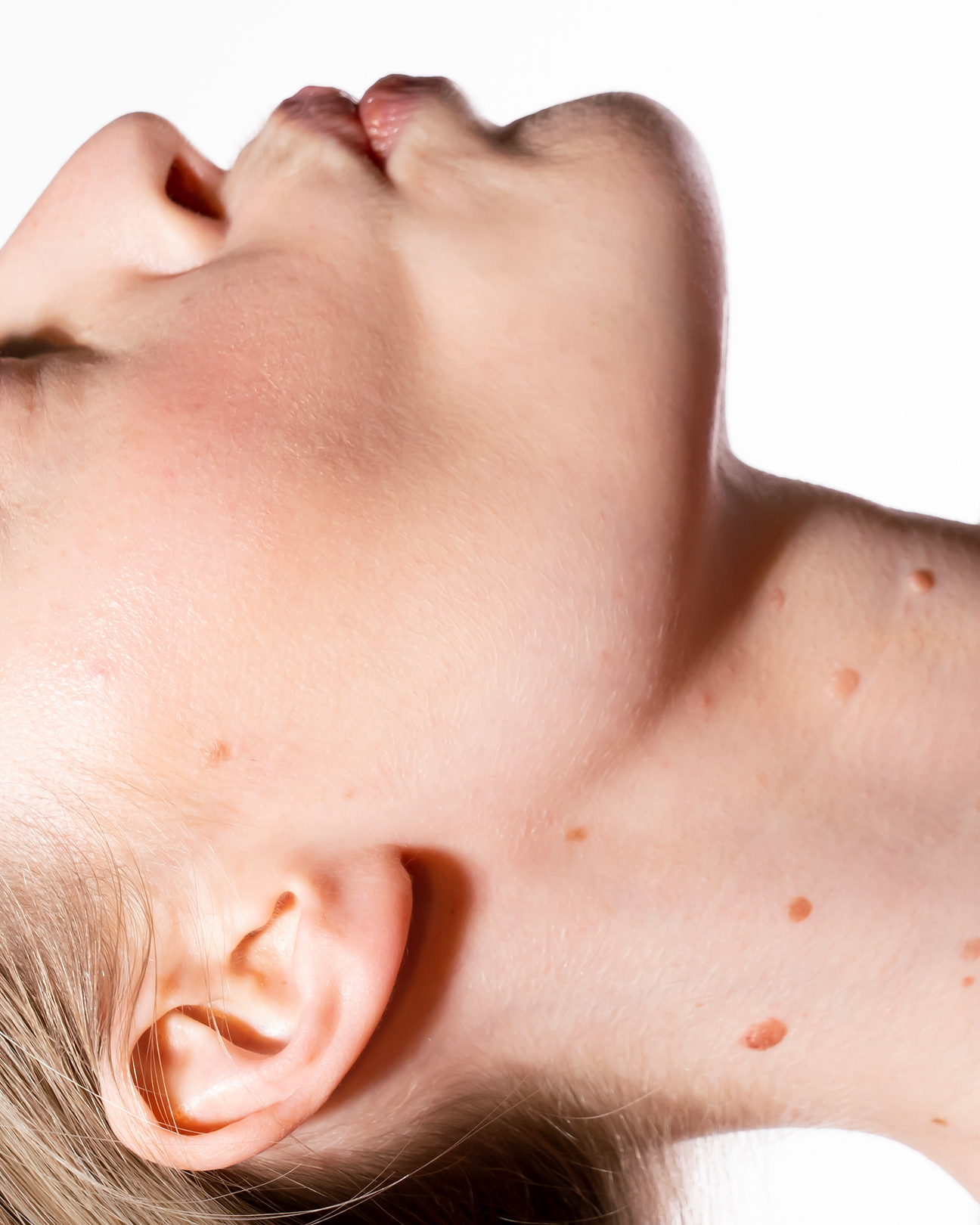 Chocolat et boutons sur le visage.