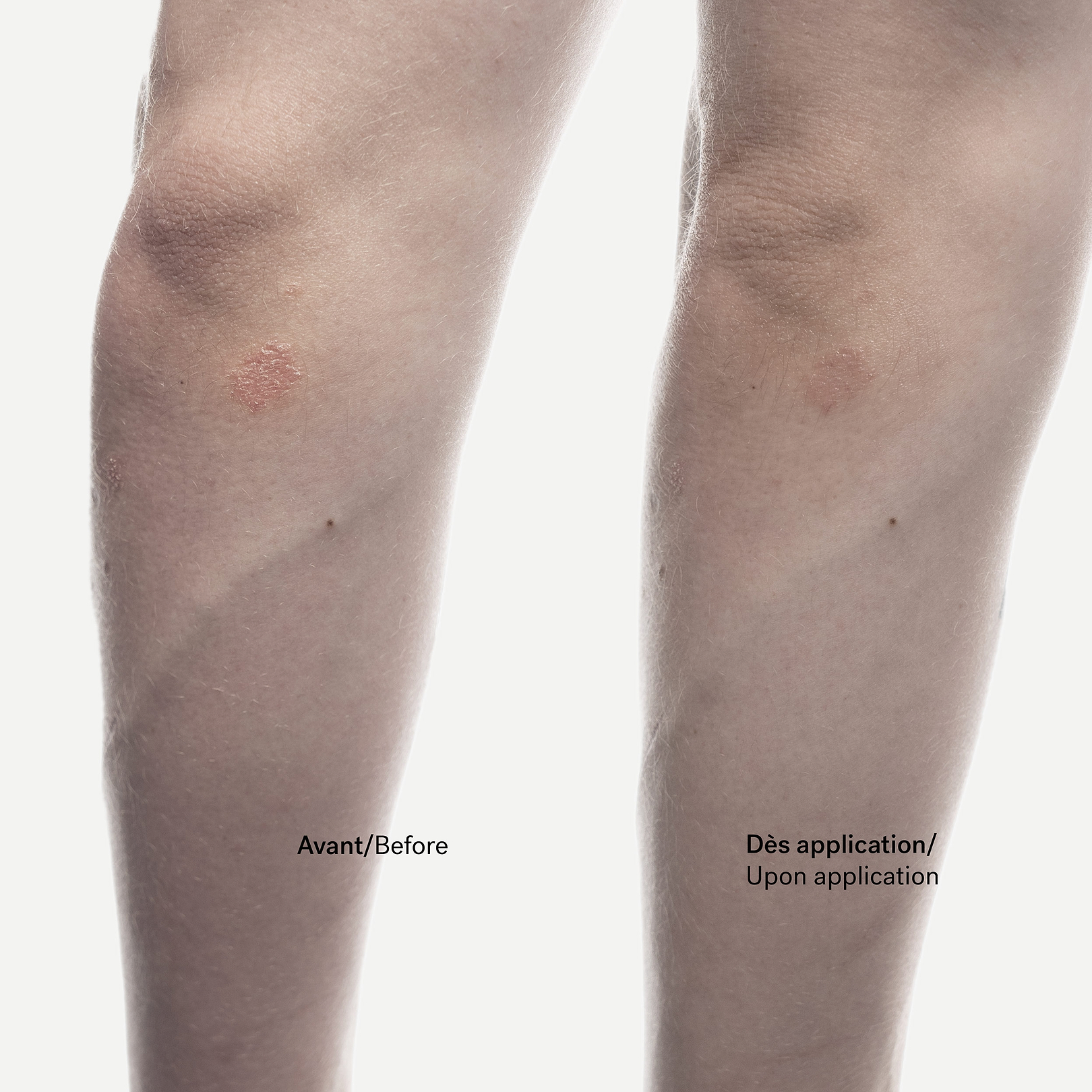 Crème Anti-Squames Phytostérols 1% + Allantoïne — Typology