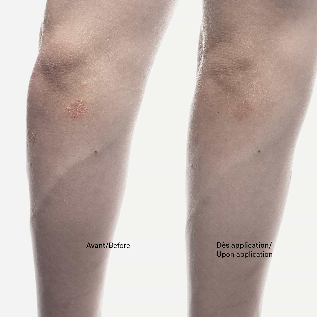 Crème Anti-Squames Phytostérols 1% + Allantoïne — Typology