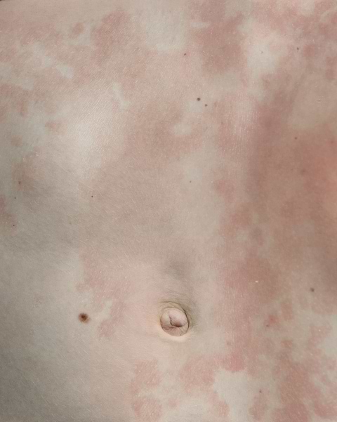 Symptômes cliniques eczéma.