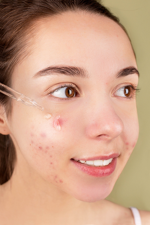 Psoriasis en goutte : de quoi s'agit-il ?