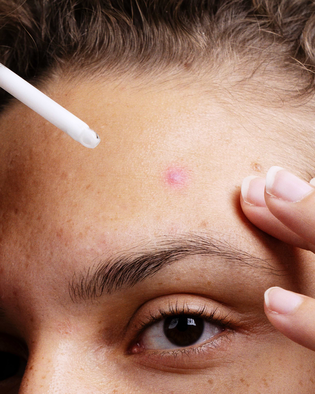 Comment agit la niacinamide contre l'acné ?