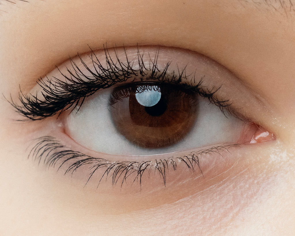 Différents types de cernes sous les yeux.