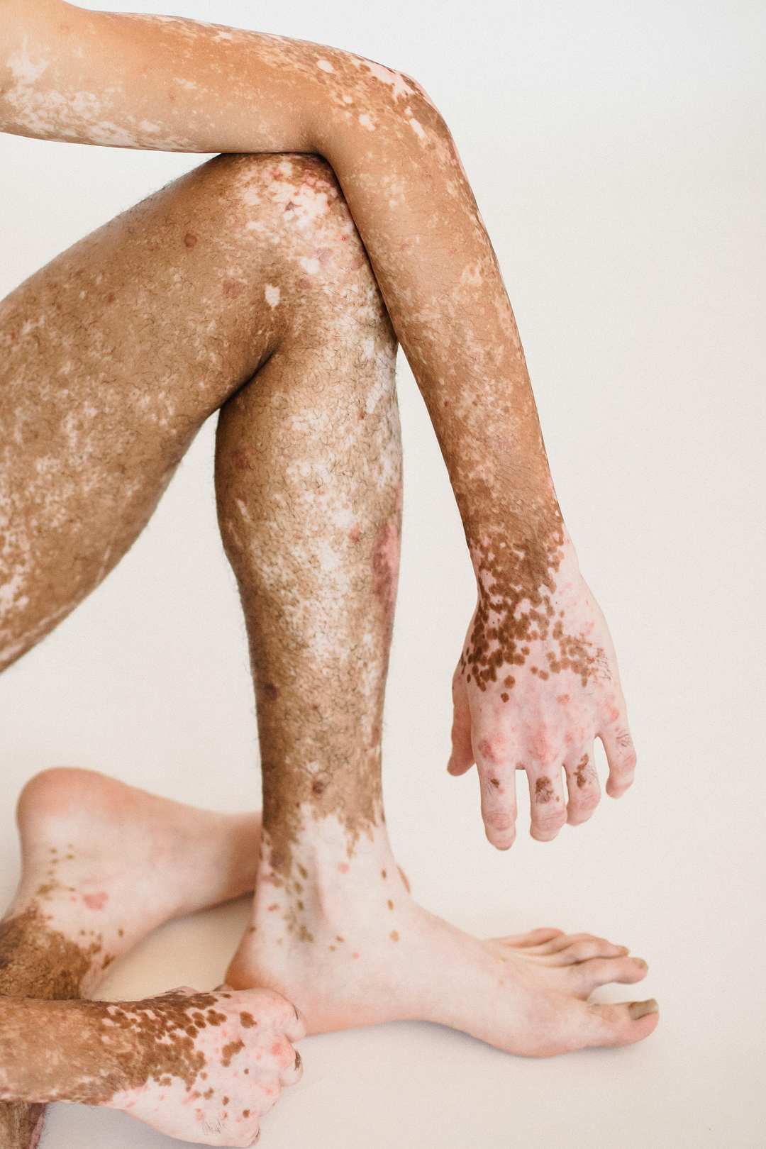 Camoufler la dépigmentation du vitiligo avec de l'autobronzant.
