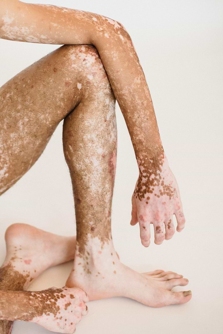 Vitiligo ou hypomélanose en gouttes