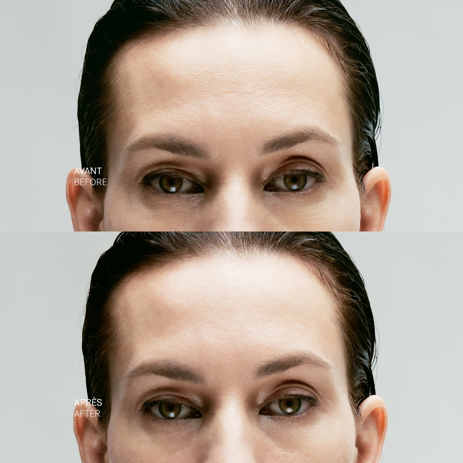 Concentré Local Tenseur Complexe de peptides inhibiteurs 10% + Acide hyaluronique — Typology