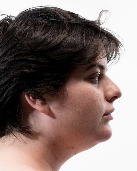 Dermatite séborrhéique ou psoriasis.