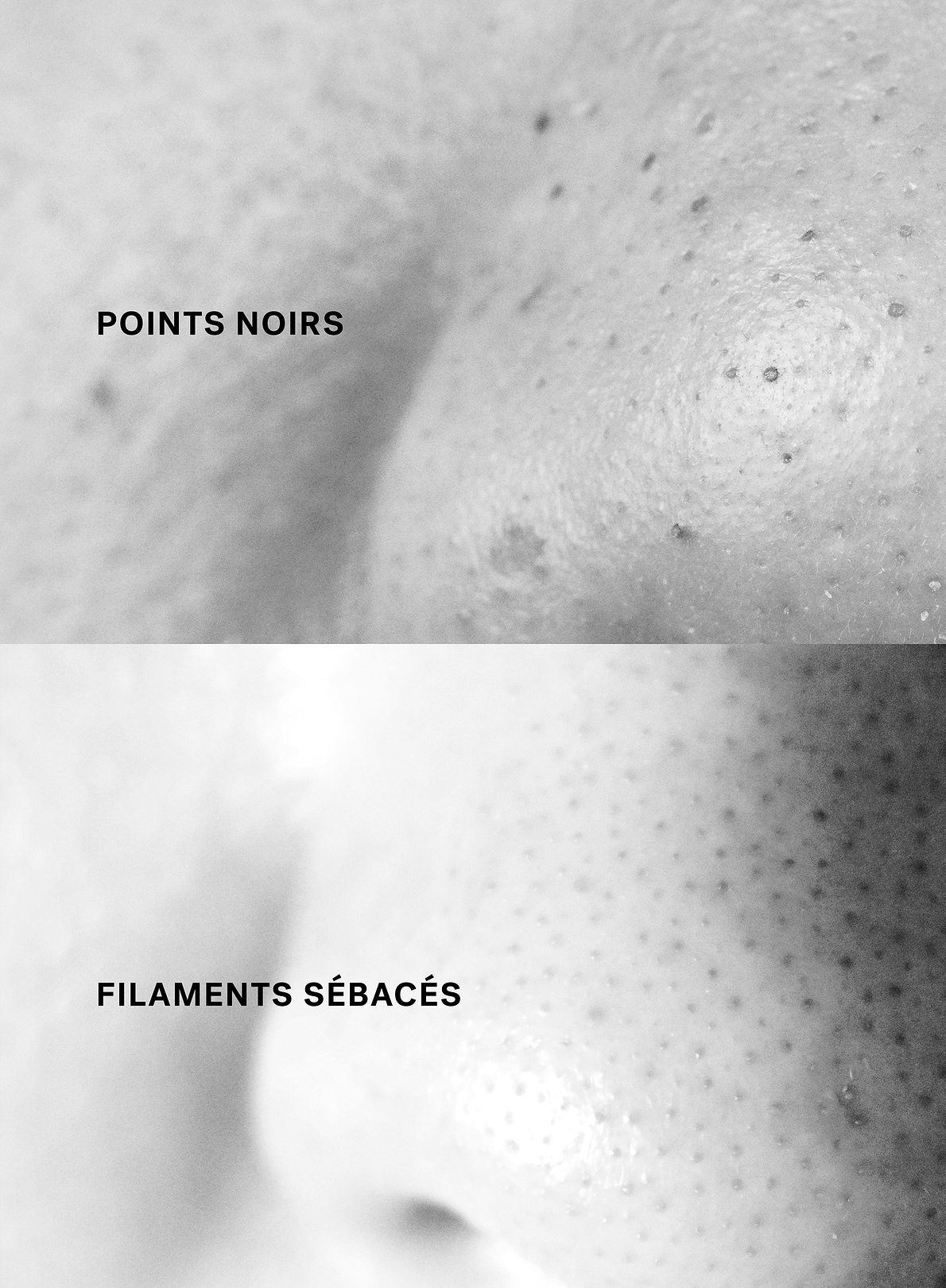 Point noir versus filament sébacé.