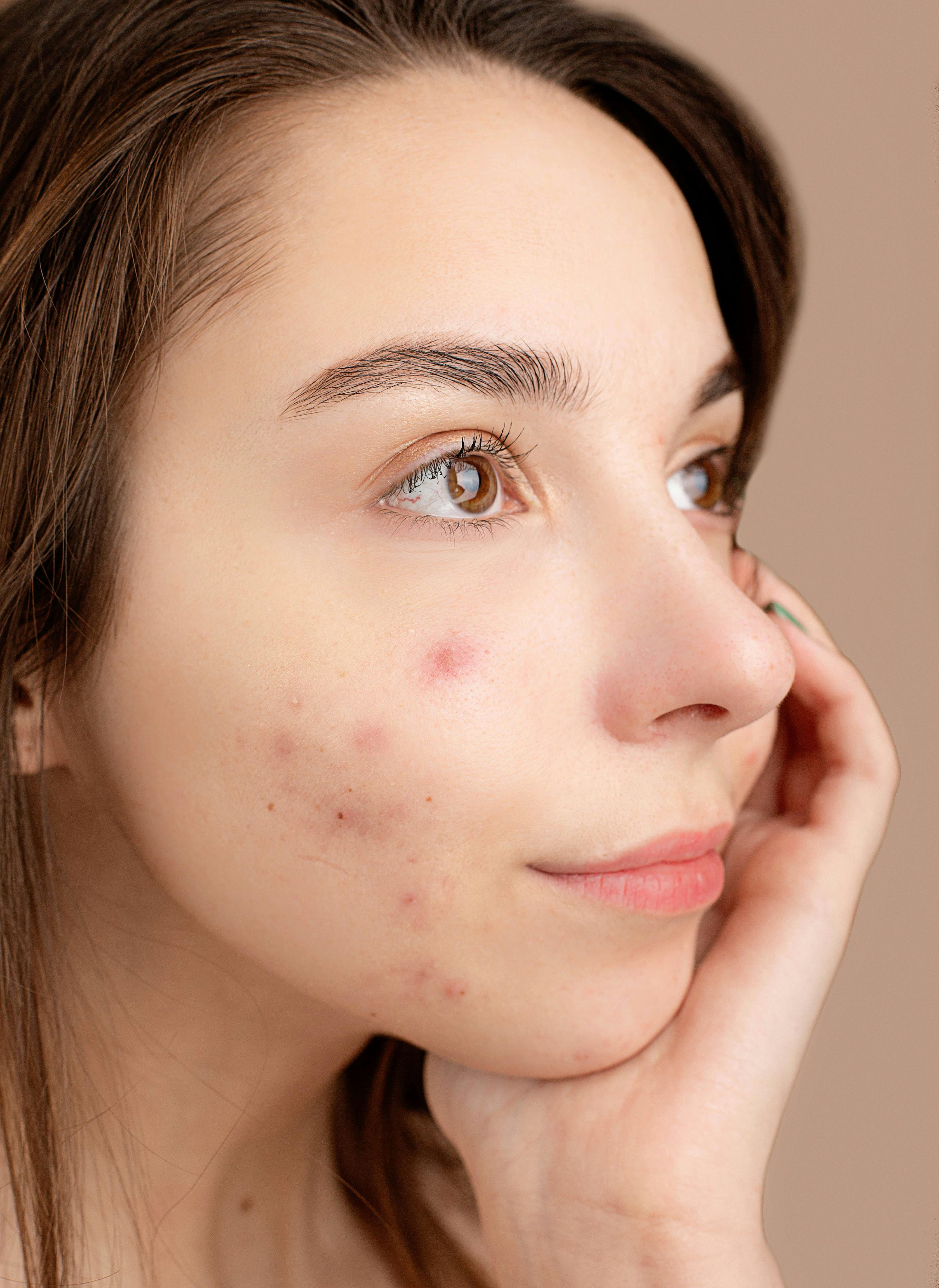 Types de boutons allergies alimentaires