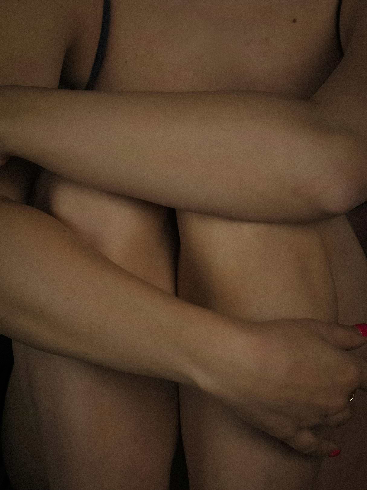 Stades d'évolution varices.