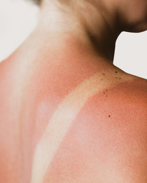 Qu'est-ce-que l'inflammation cutanée ?