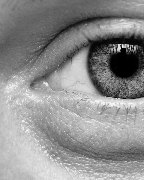 bags under the eyes