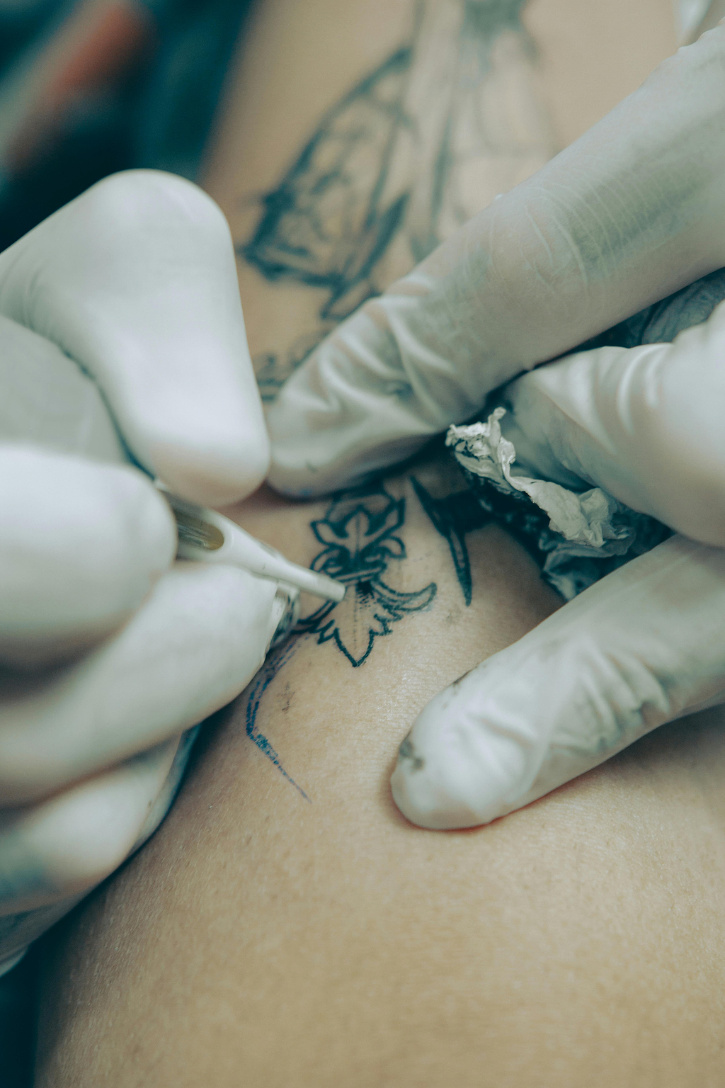 Lien entre tatouage ou épilation laser et vitiligo
