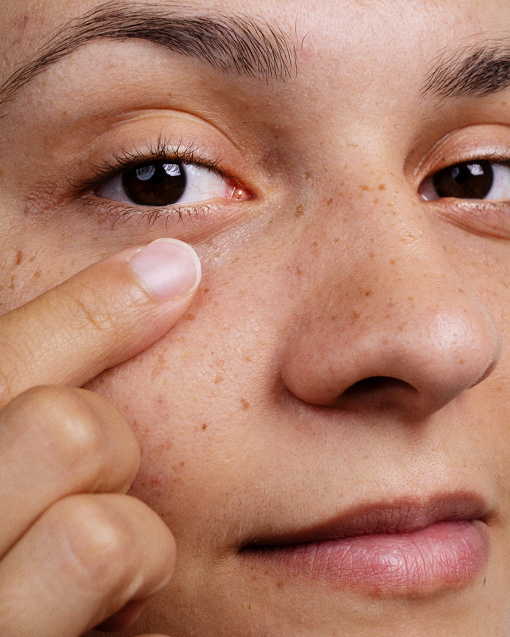 Hyperpigmentation post-inflammatoire versus érythème post-inflammatoire.