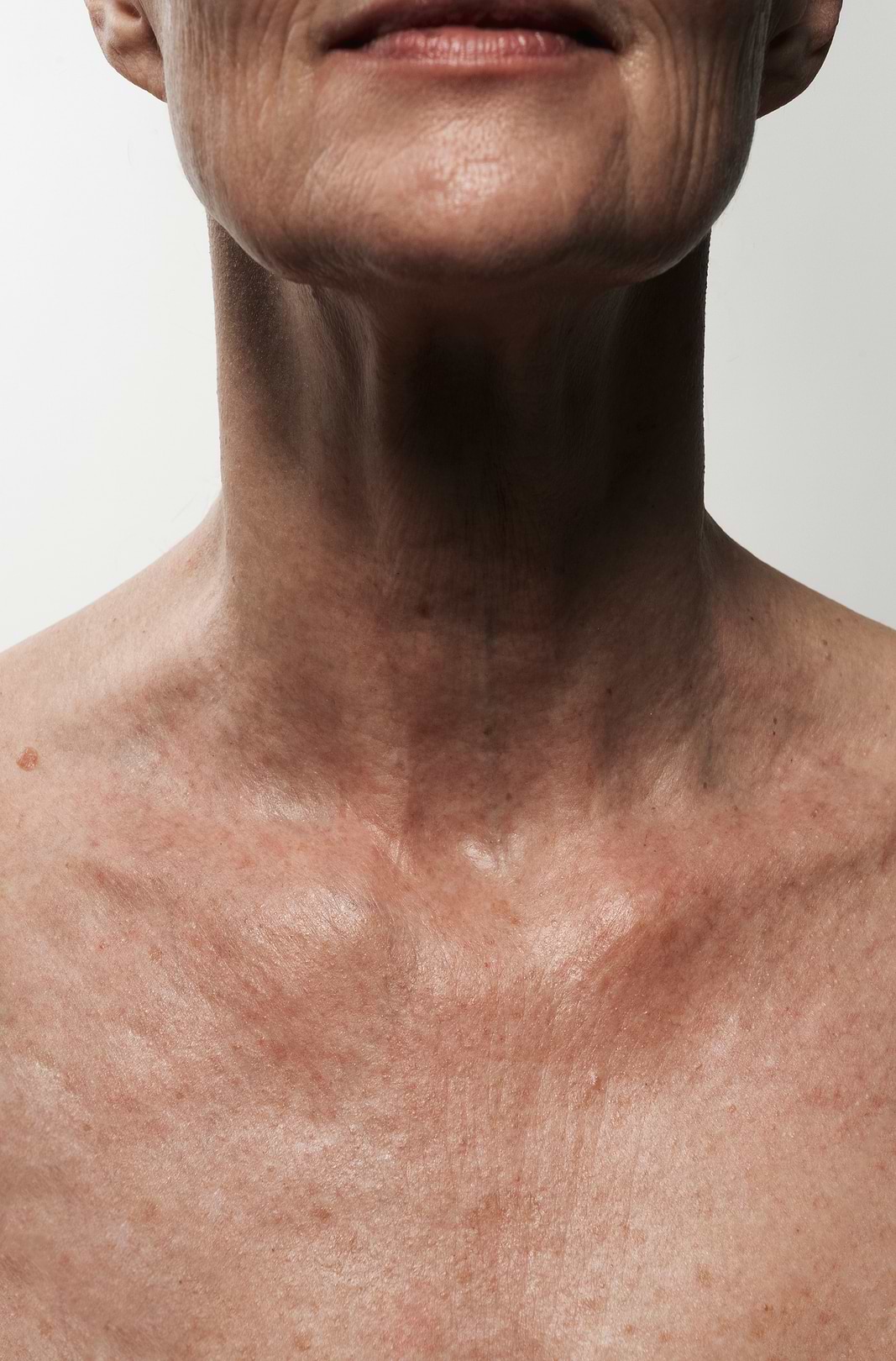 Effets ciclopirox olamine eczéma