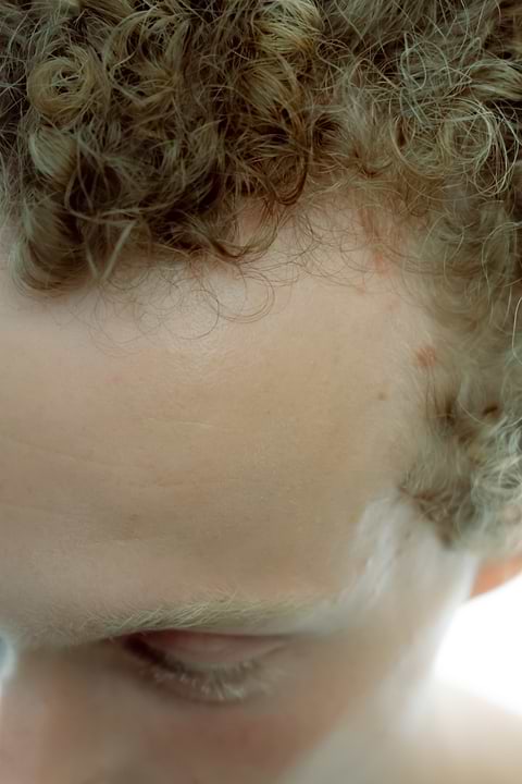 Solutions psoriasis cuir chevelu.