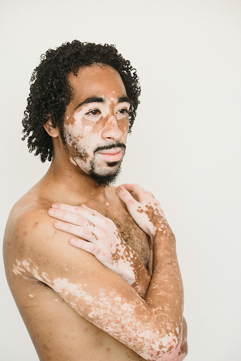 Signes du vitiligo.