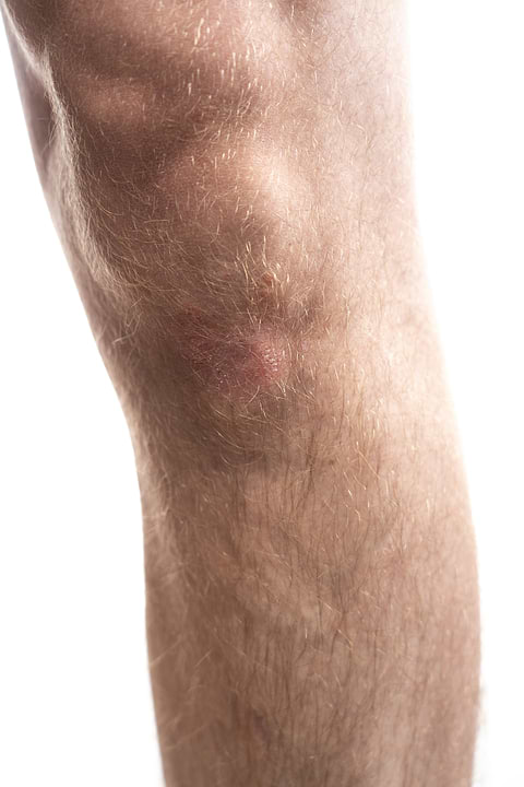 Symptômes psoriasis.