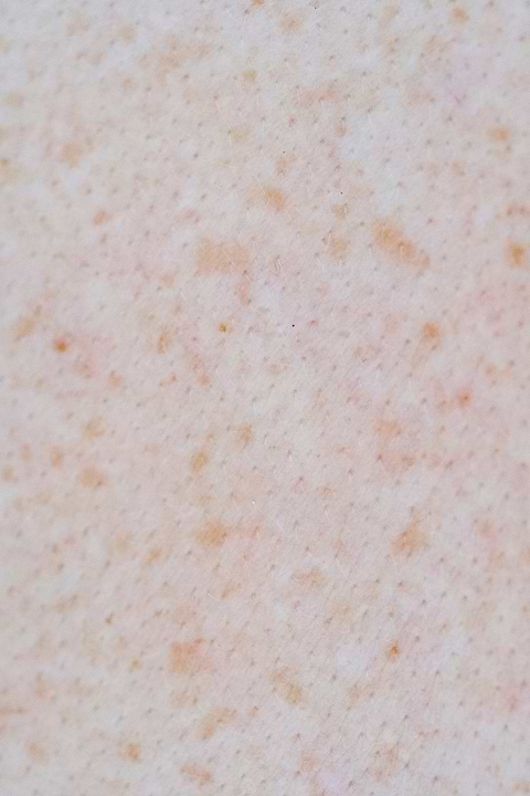 Les changements observés au sein des lentigos solaires