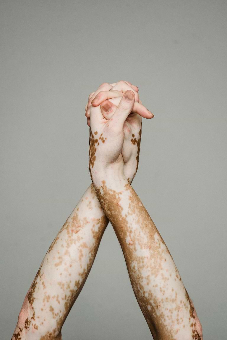 Lien entre vitiligo et cancer de la peau.