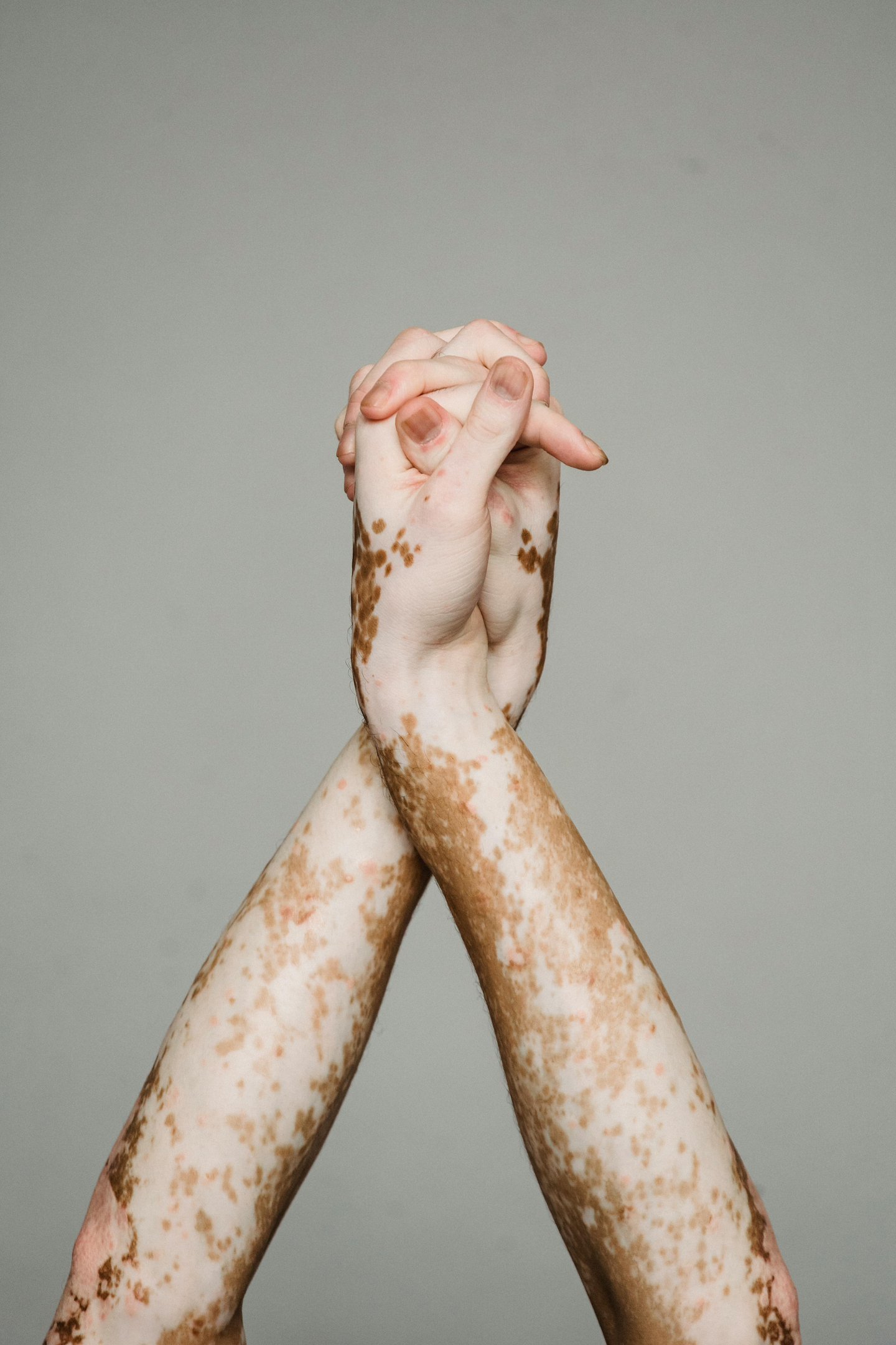 Lien entre vitiligo et cancer de la peau.