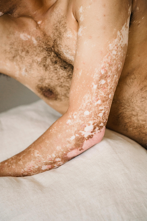 Effet de l'huile de coco sur le vitiligo.