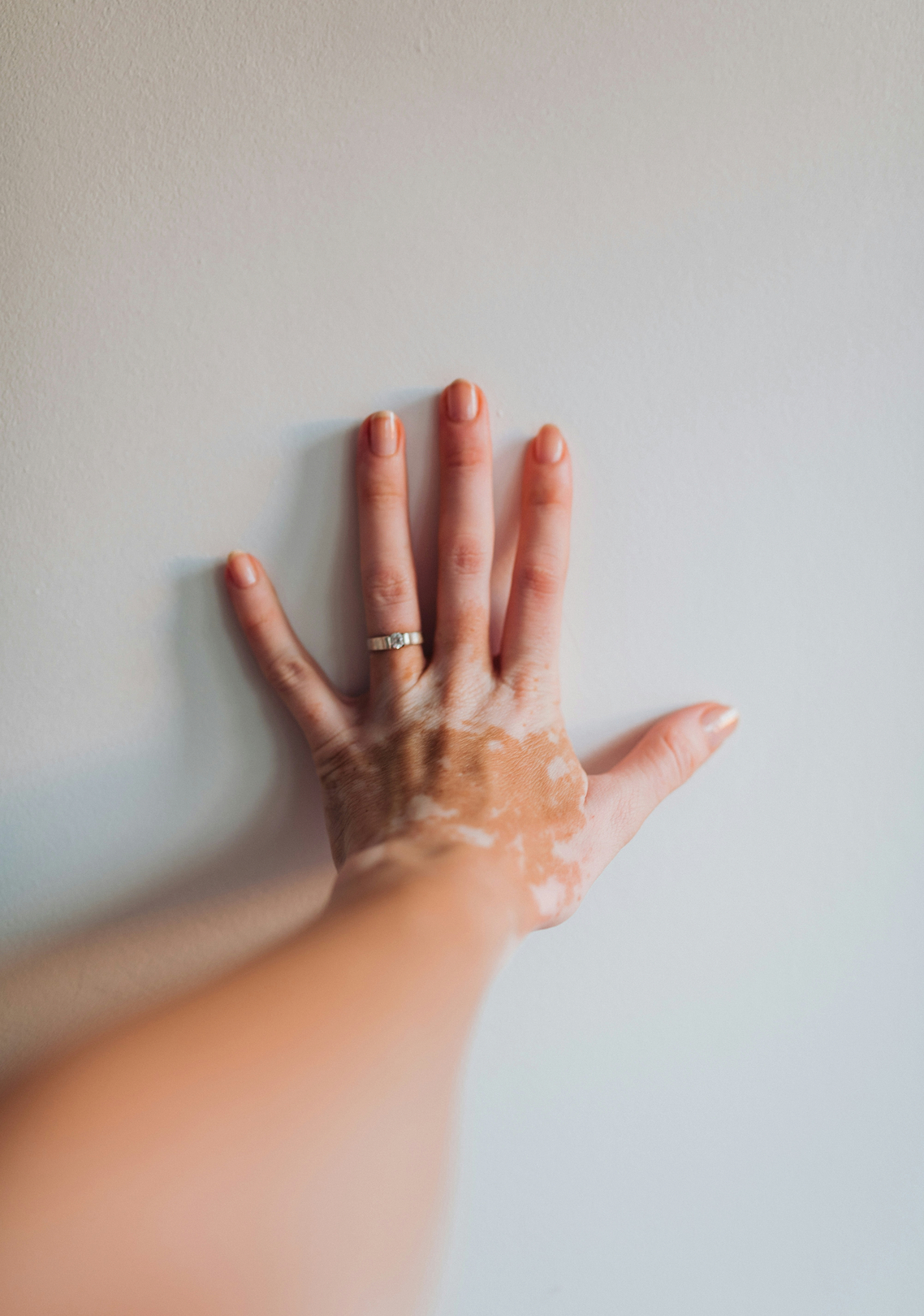Effets des probiotiques sur le vitiligo