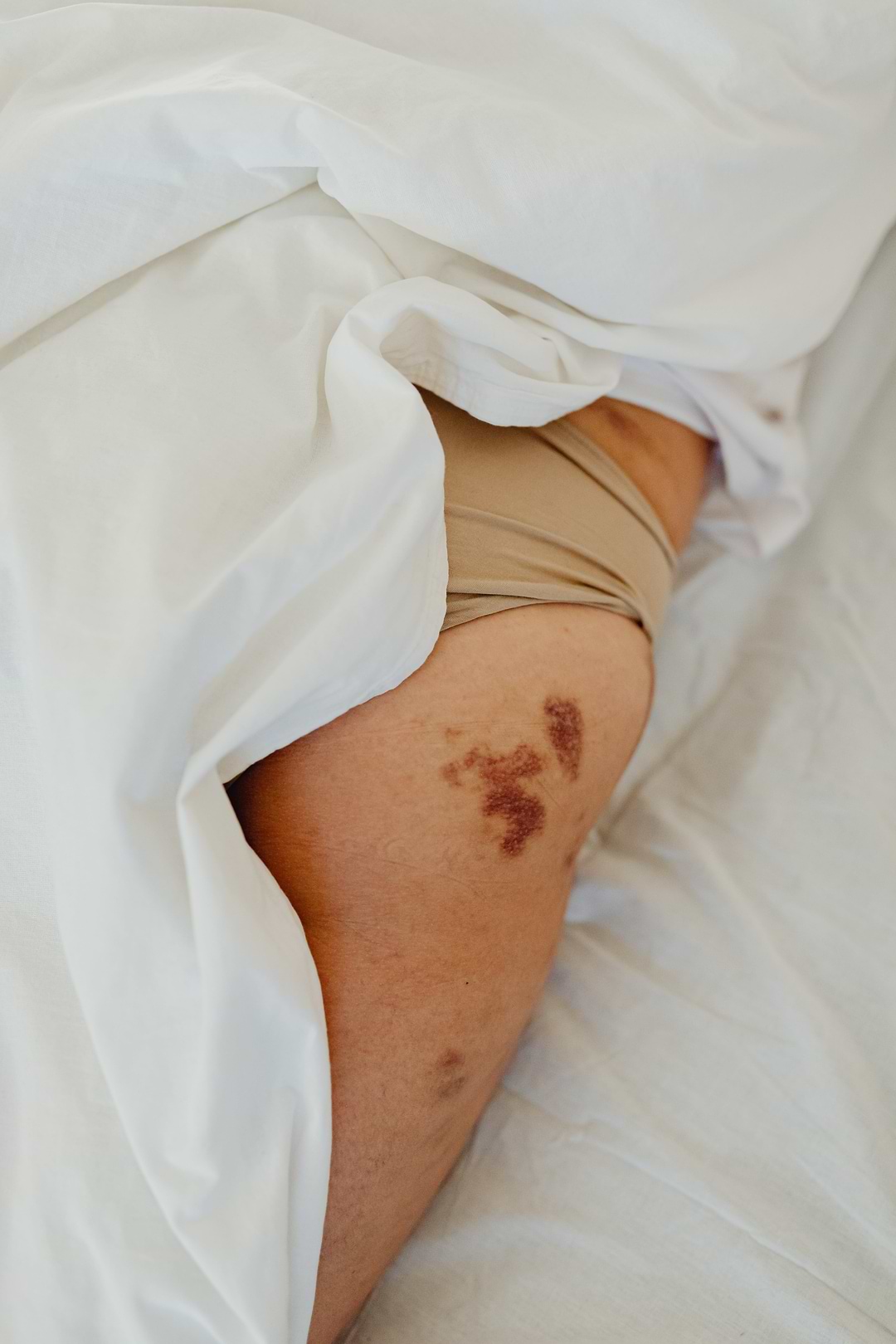 Effets arnica bleus.