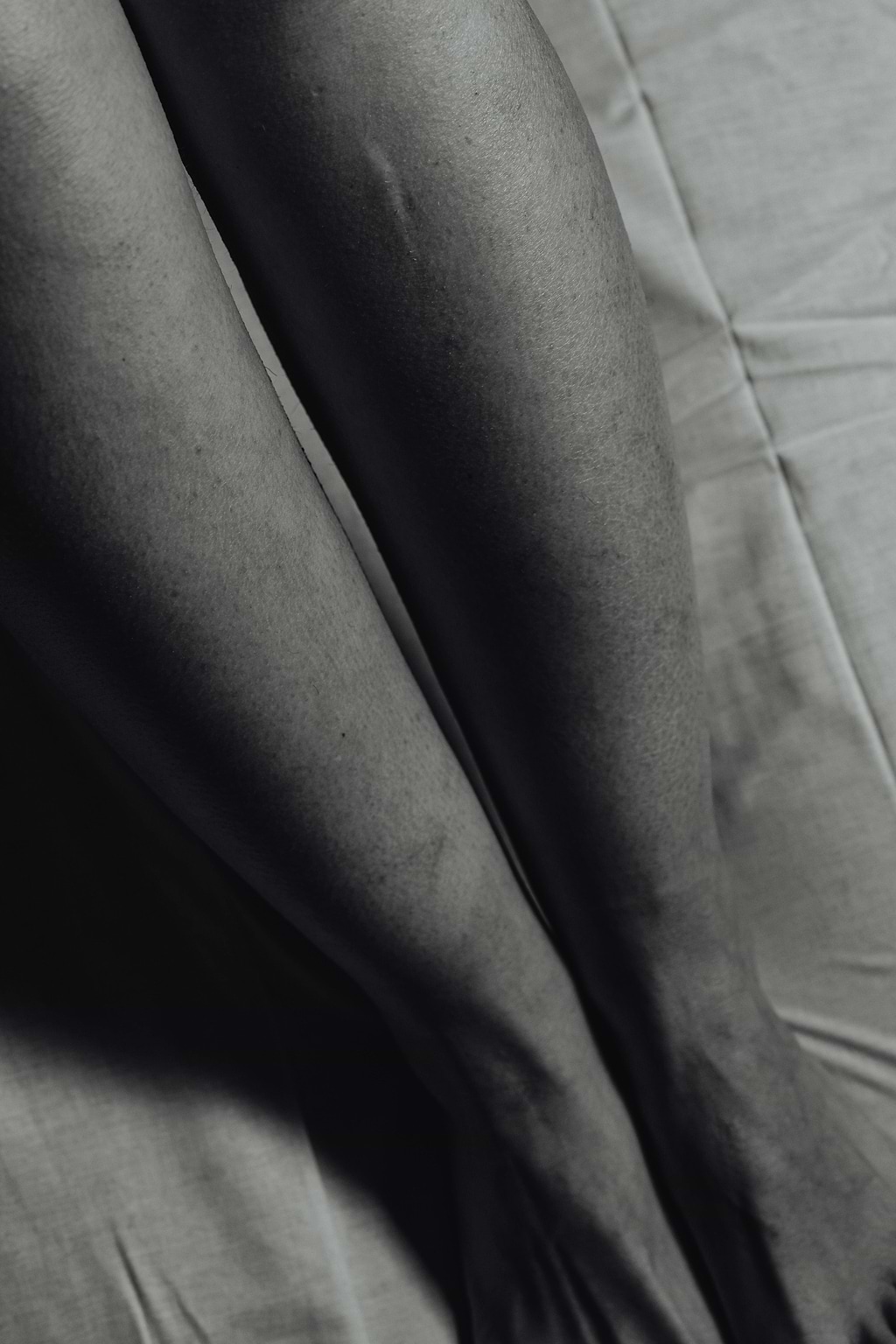 Varices hémorragiques.