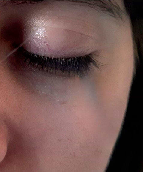 Sécheresse oculaire syndrome de Gougerot-Sjögren.