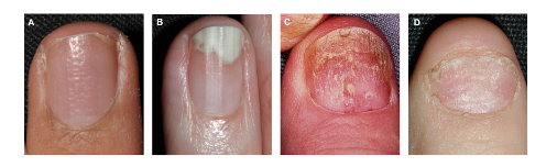 Manifestations d'une atteinte psoriasique de la matrice de l'ongle.