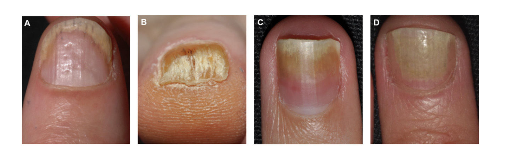 Manifestations cliniques d'une atteinte psoriasique sur le lit de l'ongle.